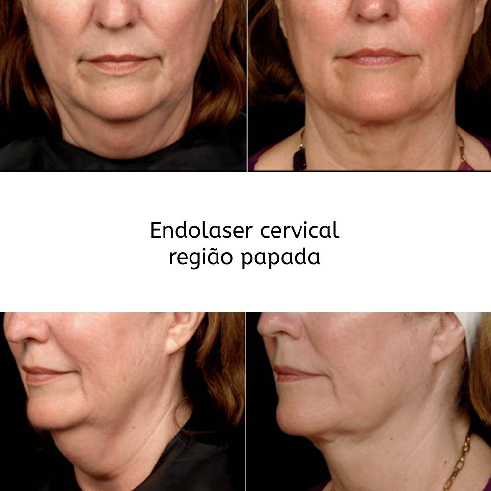 endolaser ingrid mota brasilia papada cervical endo laser clinica rejuvenescimento facial