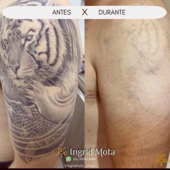 Ingrid Mota Remoção Tigre Antes e Depois