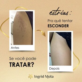 clinica-ingrid-mota-brasilia-estrias-micropuntura