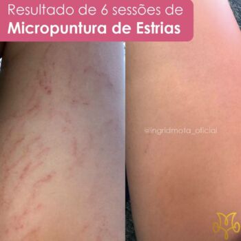 clinica-ingrid-mota-brasilia-estrias
