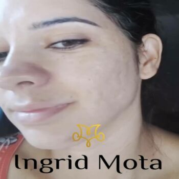 clinica-ingrid-mota-brasilia-melasma-manchas