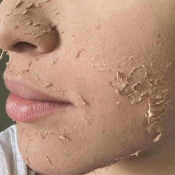 clinica-ingrid-mota-brasilia-peeling-rose-de-mer-descamação