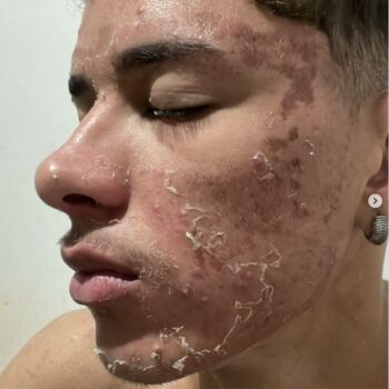 clinica-ingrid-mota-brasilia-protocolo-acne-avaliacao-cliente-processo-depois