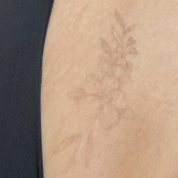 clinica-ingrid-mota-brasilia-remoção-tatuagem-micropigmentação-coxa-flor-resultado