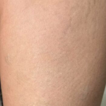 clinica-ingrid-mota-brasilia-remoção-tatuagem-micropigmentação-gaiola-coxa-resultado