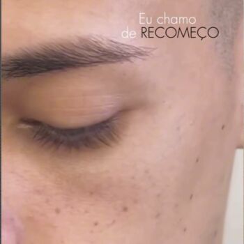 clinica-ingrid-mota-brasilia-remoção-tatuagem-micropigmentação-rosto