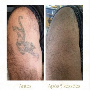 clinica-ingrid-mota-brasilia-remoção-tatuagem-pantera-laser-nd-yag