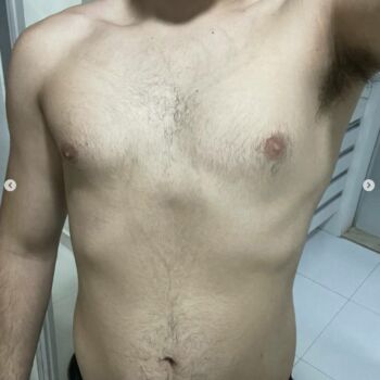 clinica-ingrid-mota-brasilia-remoção-tatuagem-veado-laser-nd-yag