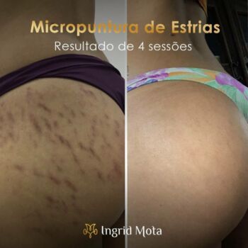 clinica-ingrid-mota-brasilia-tratamento-estrias-micropuntura